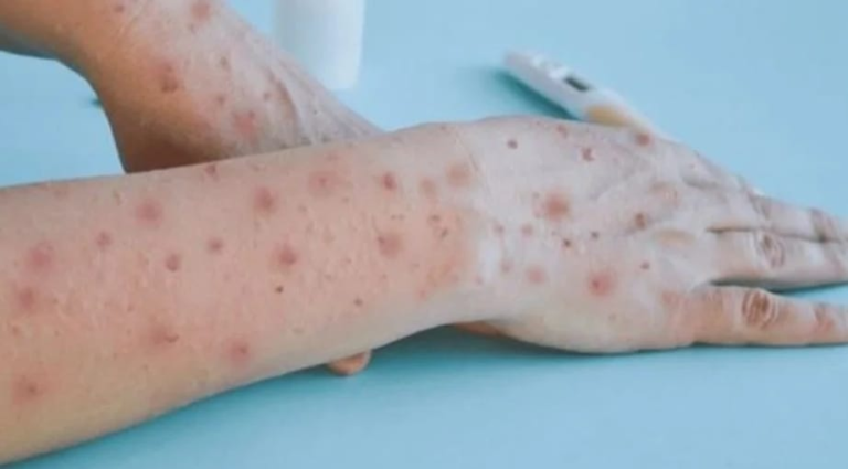 Salud Publica activa protocolo por dos casos de mpox en San Cristobal